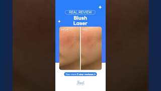 Disclosure The Procedure Process Of Blush Laser