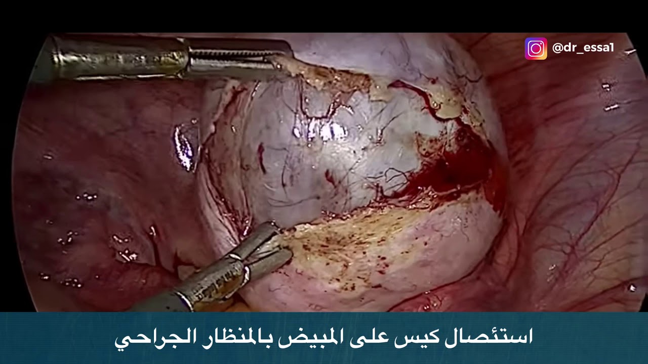 عملية استئصال كيس على المبيض بالمنظار الدكتور عيسى YouTube