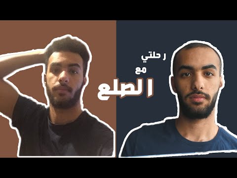رحلتي مع الصلع المبكر واستخدام المينوكسديل بداية من 17 سنة