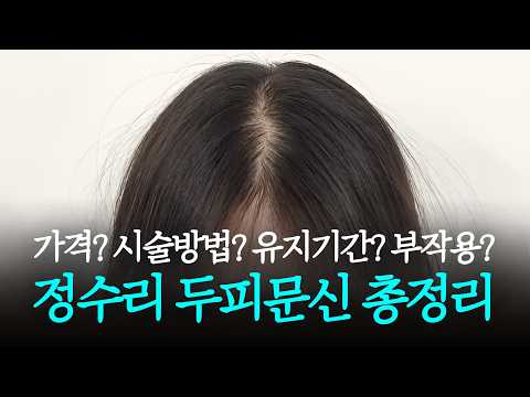 정수리 두피문신 가격 부작용 유지기간 시술방식