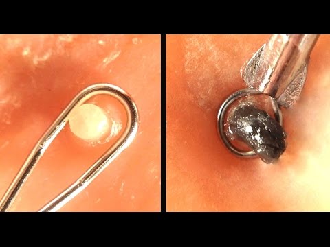 Popping Whiteheads and Blackheads Close Up