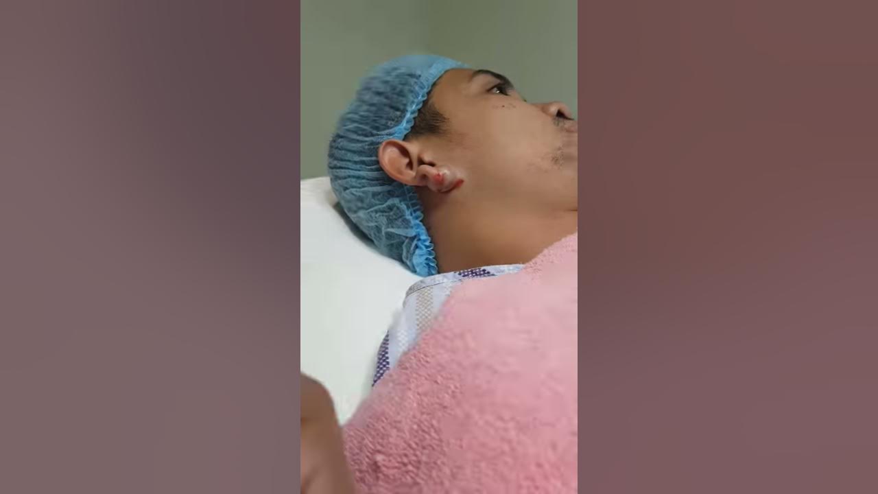 surgical-removal-of-a-large-earlobe-cyst-surgery-pimple-popper