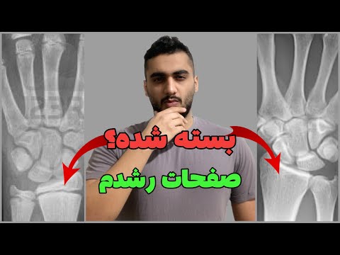 صفحات رشد کی بسته میشود عکس صفحات رشد استخوان باز و بسته کی به پایان قد با استخوان میرسم