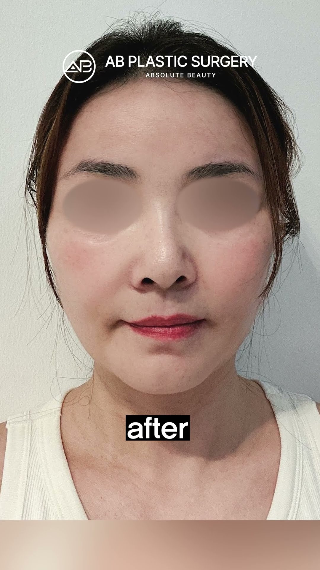 Korean Facelift Took Years Off Her Face #shorts