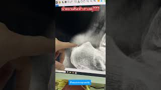 ปวดบวมส้นเท้า สาเหตุ? #หมอเก่งกระดูกและข้อ #ปวดบวมส้นเท้า #ปวดส้นเท้า #เอ็นร้อยหวายอักเสบ