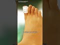 Ingrown Toenail Removal Surgery#ingrowntoenail #ingrowntoenailremoval #ingrowntoenailsurgery