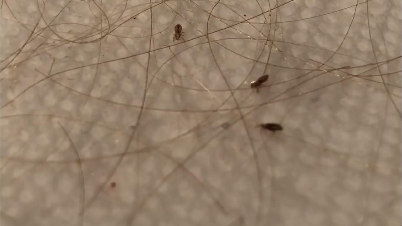 Coco Loco lice removal Destroys Lice Best Hair lice removal YouTube