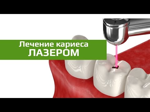 Лечение кариеса лазером: лечение кариеса без сверления