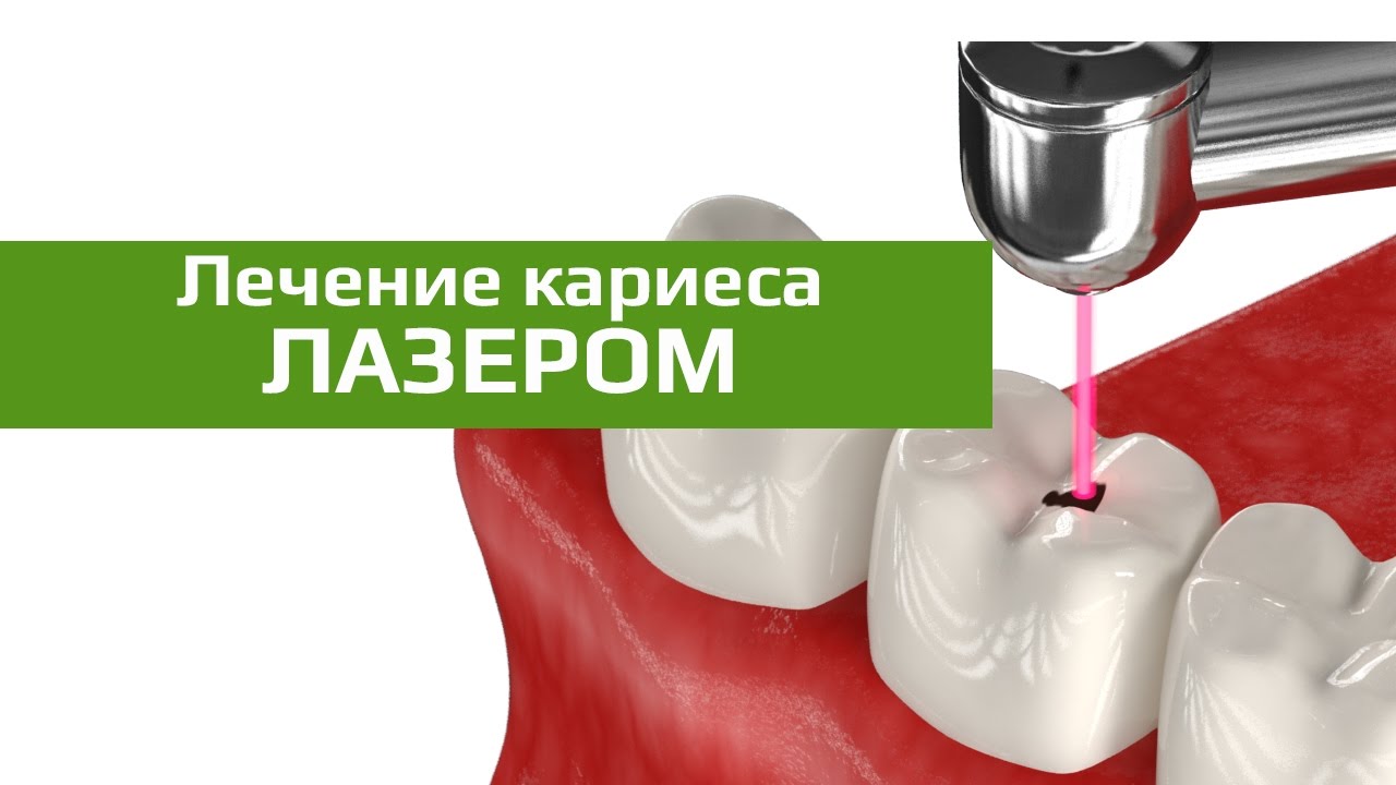 Лечение кариеса лазером Томск Янтарный сколько стоит лечение зубов томске