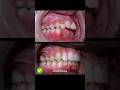 Braces overbite treatment #braces #orthodontist #dentist #dental