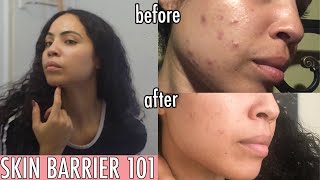 Repairing The Skin Barrier to Get Rid of Acne: Before and After Results