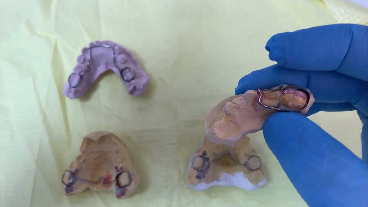 Types of space maintainers after extraction of primary teeth YouTube