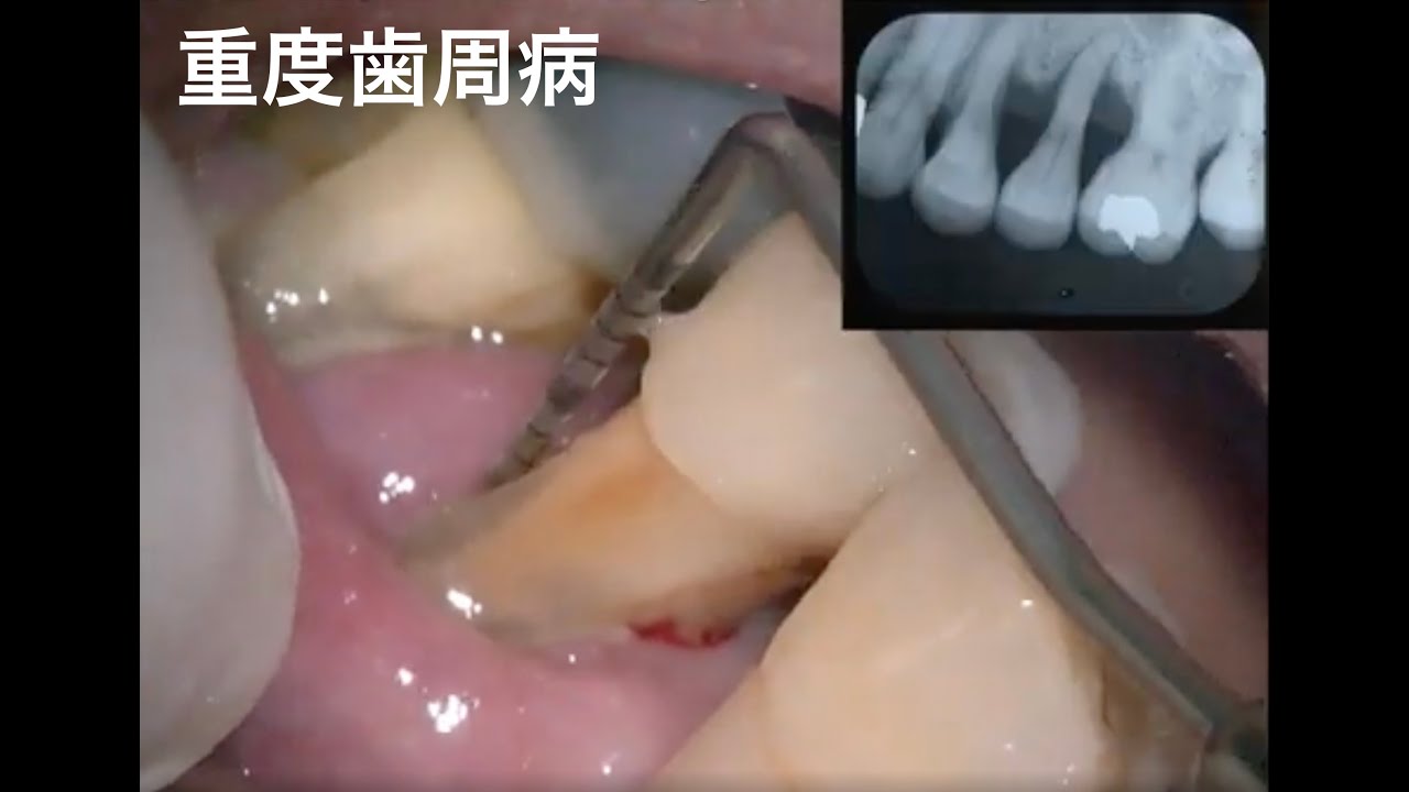 重度歯周病!歯周病を治すには、早期発見・早期治療!(角化歯肉の必要性)