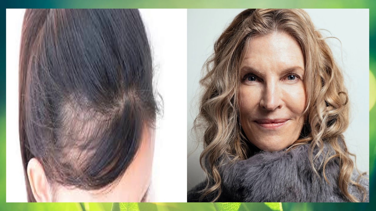 or Hereditary pattern hair loss Cure/Treatment YouTube