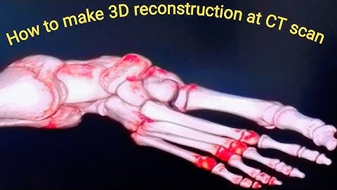 Foot CT scan. 3D reconstruction foot and ankle.