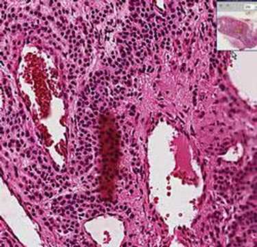 Histopathology Skin--Glomus tumor