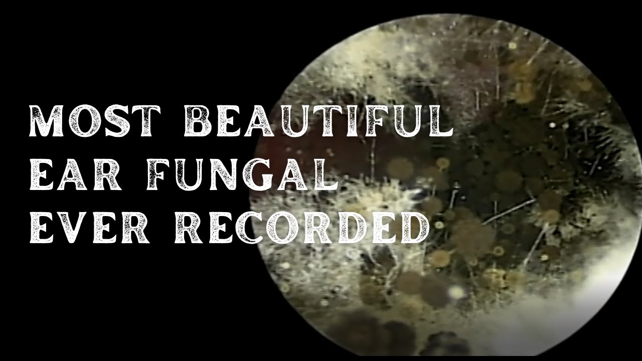 Most Beautiful Ear Fungal Ever Recorded Most Beautiful Ear Fungal Ever Recorded