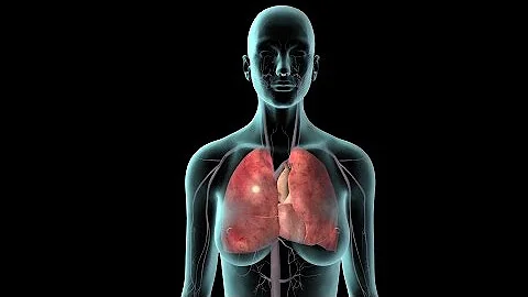 ¿Puede la insuficiencia venosa afectar a los pulmones?