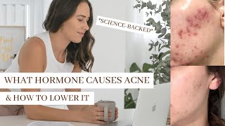 What Hormone Causes Acne? PUT AN END TO HORMONAL ACNE
