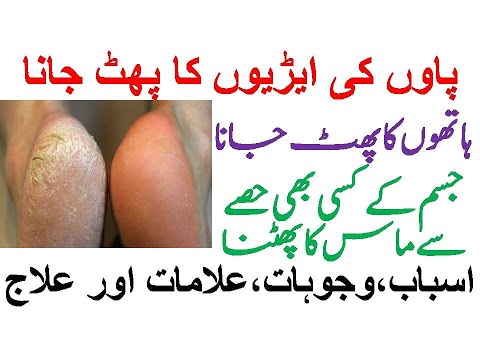 ہاتھ پاوں کی ایڑیاں پھٹ جانا / CRACKED HEELS Treatment / Hath  aur paon ki Aerion ke path jane ilaj