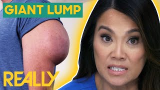 Dr. Lee Assists A Man Fearful of Losing His Arm To Massive Lipoma | Dr. Pimple Popper