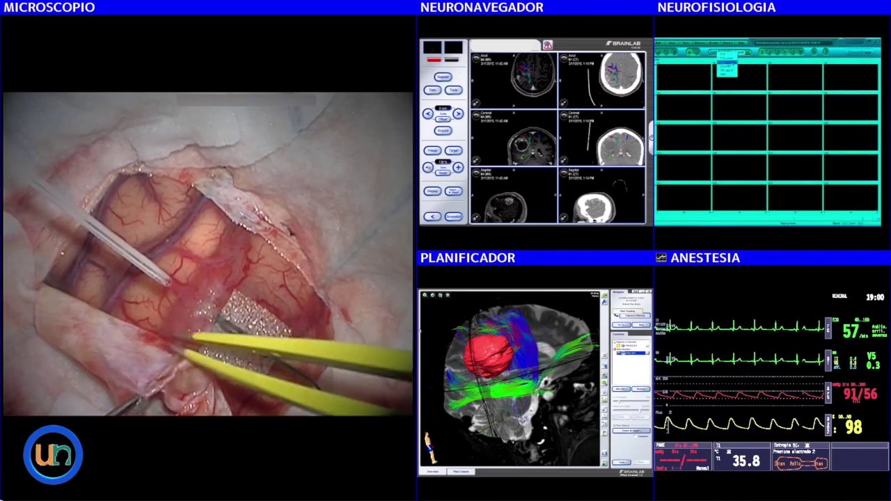 Benigno tratamiento cerebral tumor
