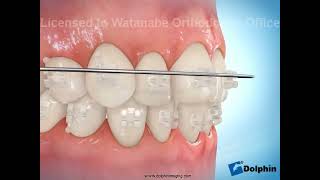 クリアブラケットでの矯正治療 | 福島市の矯正歯科 福島わたなべ矯正歯科