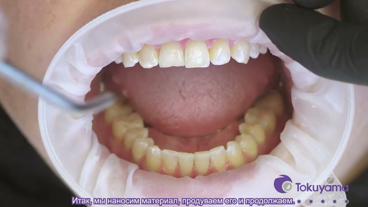 Advanced OMNICHROMA Procedure Video with Dr