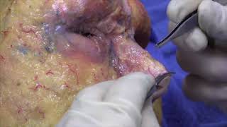 Facial Danger Zones: Filler Injection: Nose