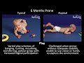 6 Month Old Baby Typical & Atypical Development Side by Side