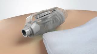 MIC-KEY* GJ Tube Maintenance and Stoma Care