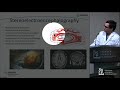 Stereoelectroencephalography (SEEG) - Carter S. Gerard, MD
