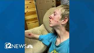 Arizona teen recovering after being attacked by bear that walked into cabin