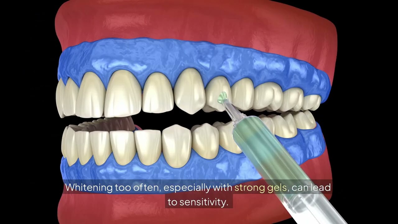 Can teeth whitening damage your enamel over time? Beverly Hills CA