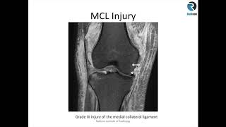 Knee MRI Part 3: Collateral Ligaments