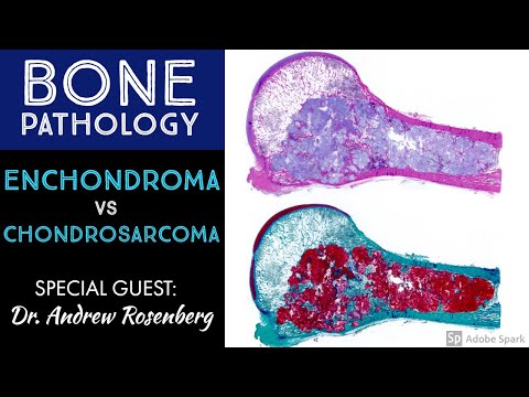 Chondrosarcoma vs Enchondroma: Bone Pathology with Dr. Andrew Rosenberg