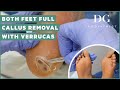 Callus removal from feet: both feet and three verruca (plantar warts) treatment