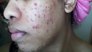 Acne/Hyperpigmentation Update... FML