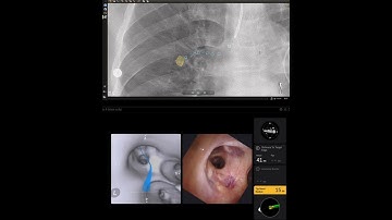 Navigating to the lesion; power of visualization