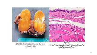Giải phẫu bệnh 6. Bệnh học tuyến giáp screenshot 5