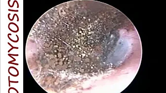 Micro-suction Cleaning of Black Fungus (Otomycosis) from Ear Canal - Full HD Unedited Micro-suction Cleaning of Black Fungus (Otomycosis) from Ear Canal - Full HD Unedited