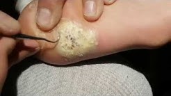 Wart Removal | Walgreens, Terrasil Fast & Natural Wart Removal Ointment | Walgreens, How to Get Rid of Warts | Home Wart Removal Treatment - Dr. Scholl's, Common warts - Diagnosis and treatment - Mayo Clinic, CLEAR Away Plantar Wart Remover and Medicated Treatment | Dr ...