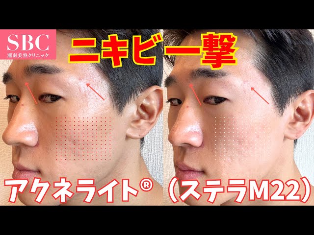 Shonan Beauty] Acne Light will deal with your acne in one hit