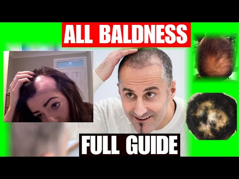 ALL TYPE OF BALDNESS Treatment you never thought ever existed for  BALDNESS , a miracle remedy!