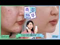 (*Eng) 2달 동안 구독자님 피부 고민 해결함!!? ❤ 민감 지성 스킨케어 루틴 Do& Don't by 디렉터파이