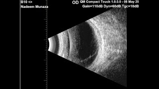 Traumatic Retinal Detachment (PVR)
