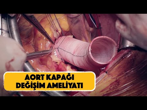 Torasik Aort Anevrizması | Aort Balonlaşması Açık Ameliyat | Prof.Dr. Selim İsbir