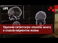 Удалили гигантскую опухоль мозга и спасли пациентке жизнь