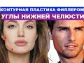 Углы нижней челюсти / Пластика филлером / Dr Rinat Sitanovich