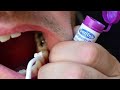 How to fix a broken tooth with dentemp or dentek tooth filling and crown repair